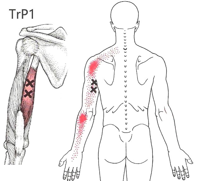肱三头肌TrP1jpg.jpg
